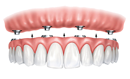 Example of All-on-4® Dental Implants